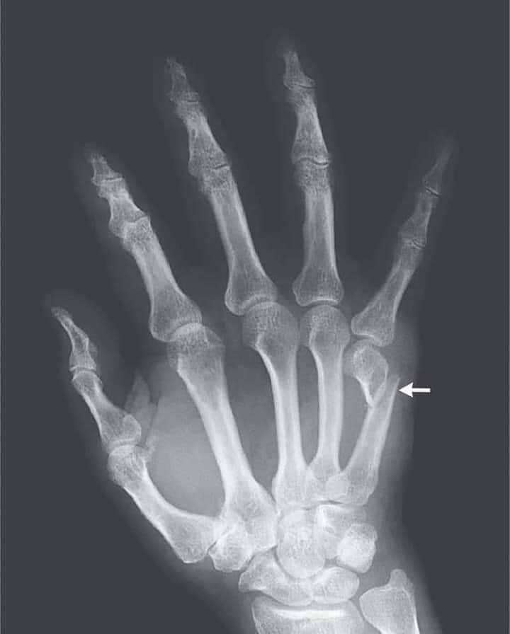 radio-main-cassée-blessures-boxeur